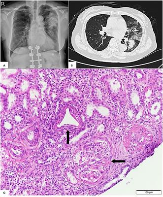 Case Report: Anti-neutrophil Cytoplasmic Antibody-Associated Vasculitis With Acute Renal Failure and Pulmonary Hemorrhage May Occur After COVID-19 Vaccination